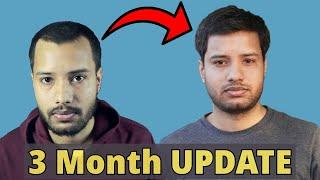 3 Month Result | Hair Transplant in 2024 | QHT REGROW