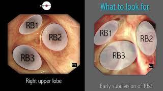 Mastering Bronchoscopy for Thoracic Surgery: Chapter 2