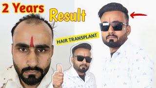 2 Years Hair Transplant Result || Patient Review || Hair Transplant in MP