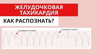 Желудочковая тахикардия. Как распознать? Как отличить от наджелудочковой тахикардии?