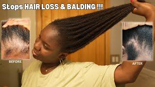 Use This Once a Week and Your Hair Will Never Stop Growing| DIY for HAIR LOSS & BALDING‼️