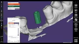 EXOCAD. Сканбоди Geo medi Scanbody