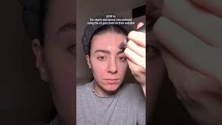 Microneedling at home
