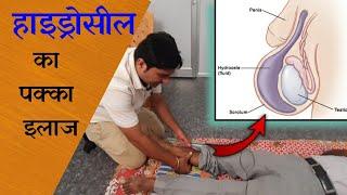 Hydrocele Treatment in Neurotherapy and Home Remedies