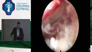 Endoscopia transforaminal na coluna degenerativa – Dr. Ralf Wagner