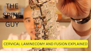 Cervical Laminectomy and Fusion Explained