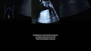 #узи #кистабартолиниевойжелезы #армдиассистент