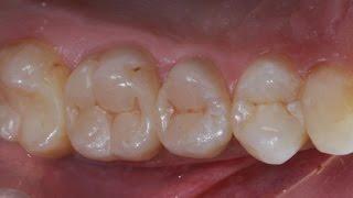 Реставрация и эндодонтическое лечение боковых зубов. Resto & Endo of posterior teeth