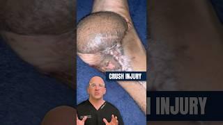 Foot Amputation vs. Free Flap Skin Reconstruction #shorts
