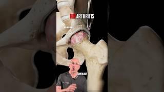 Shocking Look At Hip Arthritis Damage⁉️