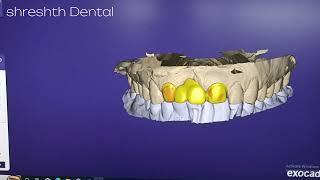 Mastering Zirconia Crown Design - Easy Exocad Smile Design Tutorial