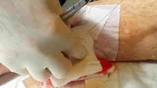 Suturing fragile skin using Hypafix support. #36