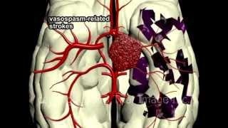 Circle of Willis Anatomy and Brain Aneurysms video by Dr. Cal Shipley, M.D.