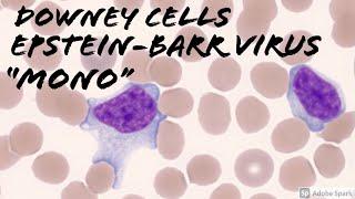 Downey cells (reactive lymphocytes) in Mono/Infectious Mononucleosis/EBV/Epstein-Barr Virus