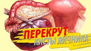 ПЕРЕКРУТ кисты яичника  Важная информация