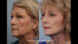 Deep Plane Facelift Testimonial | Life-Changing Effects