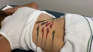 Example Electro DN For Chronic Low Back Pain | Orlando FL | Pursuit Physical Therapy