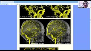 BANANA BITES -- Preoperative Sphenoid Wing Meningioma Embolization Venous and Arterial Points