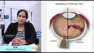 Let's spread awareness about Retinopathy of prematurity and its screening. Let no baby become blind.