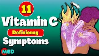 11 Vitamin C deficiency symptoms