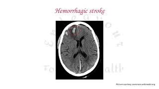 Pediatric Stroke/ASA guidelines 2019/AHA guidelines 2019/Stroke in children