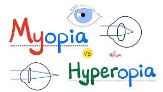 Myopia vs. Hypermetropia - Near sightedness vs Far sightedness - Ophthalmology Series