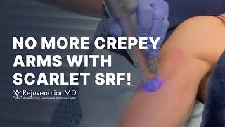 All-Around Rejuvenation with Scarlet SRF