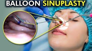 Balloon Sinuplasty Unveiled: A Painless Path to Clear Sinuses (3d Animation)