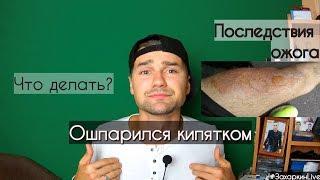 Облился кипятком. Большой ожог. Как оказать помощь