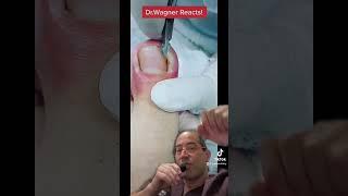 SUPER ANGRY INGROWN TOENAIL WITH ABSCESS#shorts #ingrown_toenail