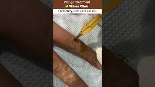 Vitiligo treatment at skinaa clinic #vitiligomodel #vitiligo #vitiligotreatment #skinaaclinic