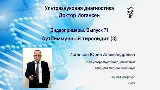 Ультразвуковая диагностика. Доктор Иогансен. Видеопримеры. Выпуск 71. Аутоиммунный тиреоидит (3).