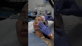 Thread Lift! #threads #threadlift #noninvasive #noninvasivefacelift