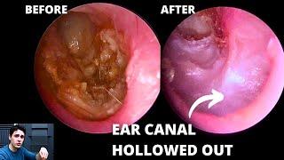 The Importance Of Angled Endoscopes (Hidden Pathology)