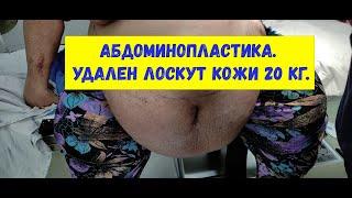 Пластика живота. Случай из практики. Пациент весом 150 кг. Удален лоскут кожи весом 20 кг.