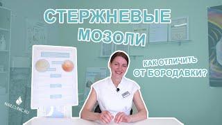 Стержневая мозоль. Удаление стержневой мозоли.