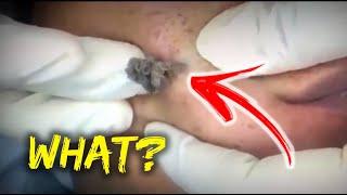 Como Remover Cravos do Rosto - Removendo CRAVOS e ESPINHAS GIGANTES #011