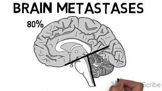 Brain Metastases