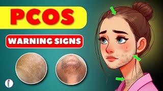 7 Warning signs that you might have PCOS | PCOS Symptoms | PCOD