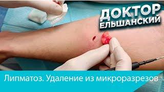 Липоматоз  Удаление липом из микроразрезов