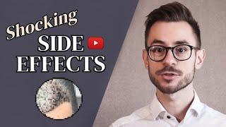 Hair Transplant Side Effects [5 MOST COMMON]