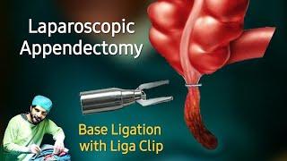 Appendectomy with Liga Clip - Dr Tayyab Riaz Ch