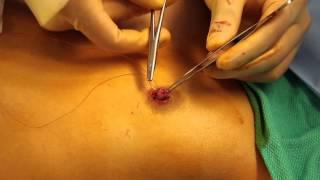 Inverted Nipple Repair Revisited: A 7-Year Experience