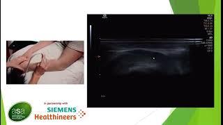 Ultrasound of the RCL and LUCL