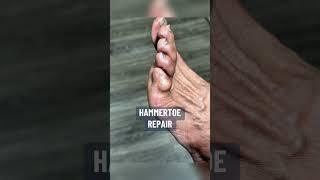Hammertoe Repair #podiatry #feet #footcare #hammertoe #hammertoesurgery