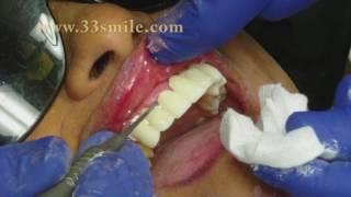 Dental Crowns and Bridges Procedure at Cosmetic Dental Associates in San Antonio, TX