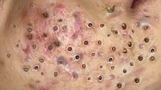 Loan Nguyen Acne Treatment 102e