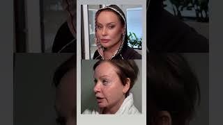 Наша шикарная Жанна Эппле. Невидимая подтяжка лица #сергейсвиридов #пластикатела #подтяжкалица