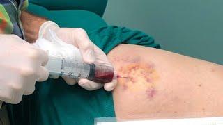 Gumball's Hematoma Aspiration by Dr. John Gilmore
