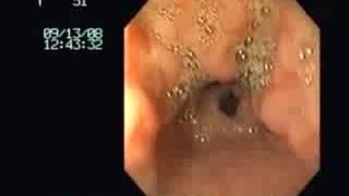 erosive gastritis